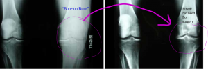 Knee Regeneration Replacement Surgery Avoided proof.