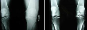 Knee Regeneration Replacement Surgery Avoided.